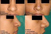Before After Pictures,Nose job,Rhinoplasty,Delhi